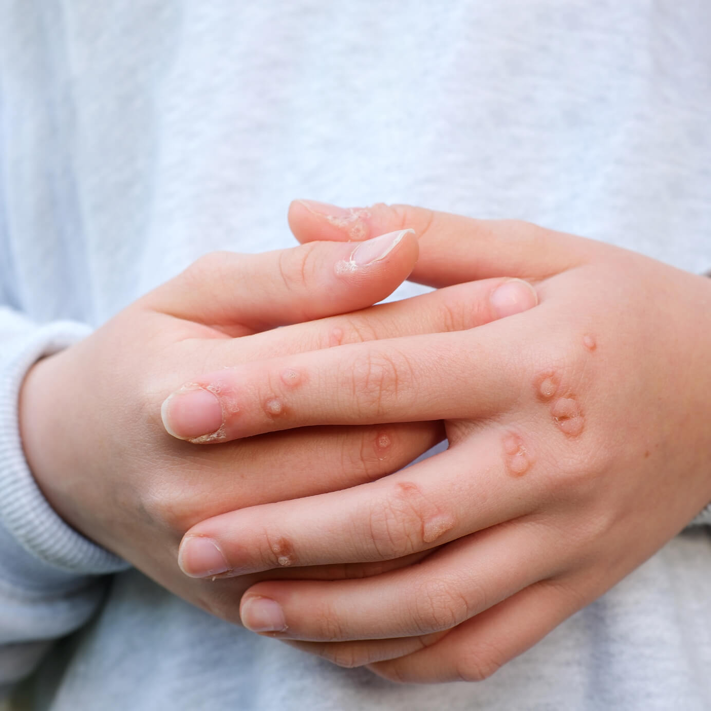 WHS - Warts - Banner